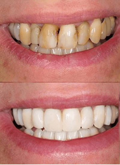 before and after photos of teeth