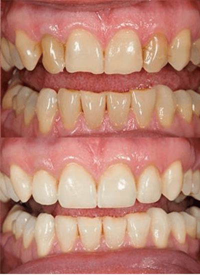 before and after photos of teeth