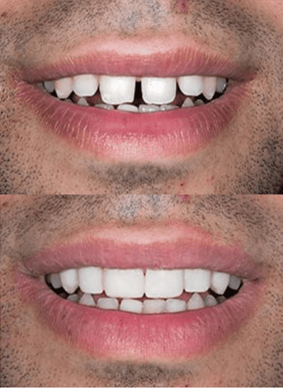 before and after photos of teeth