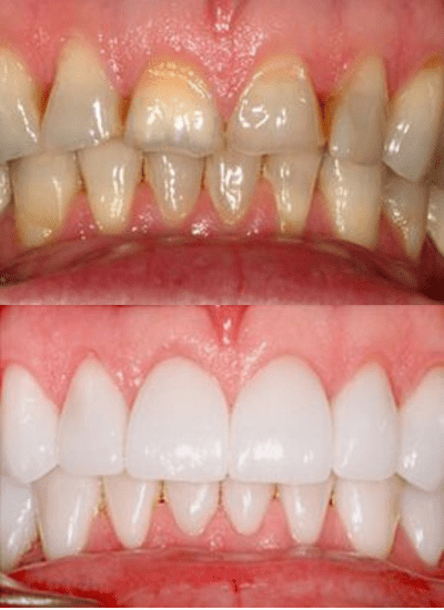 before and after photos of teeth