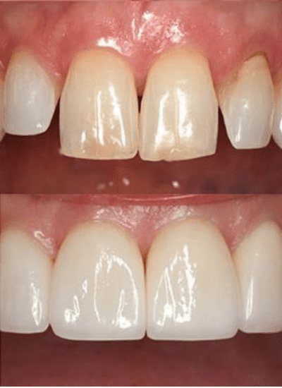 before and after photos of teeth