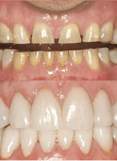 before and after photos of teeth