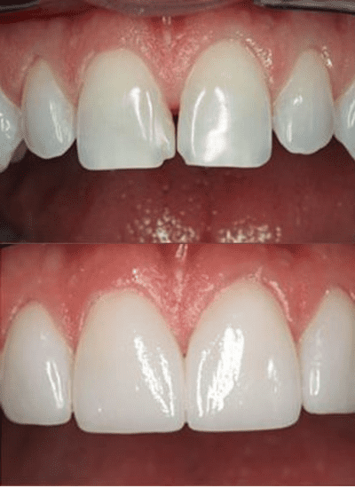 before and after photos of teeth