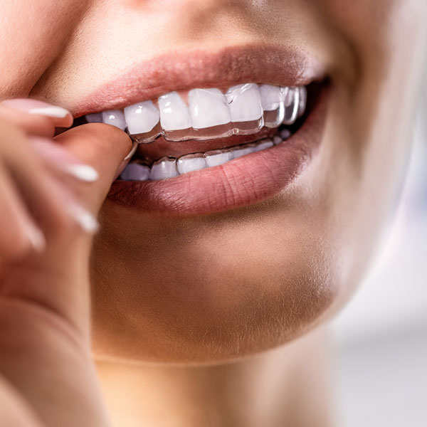 closeup of woman placing clear aligners on teeth
